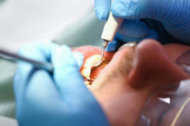 Best Emergency Dentist for Knocked-Out Tooth in Hudson, IL
